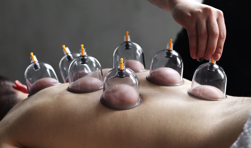 Cupping Therapy